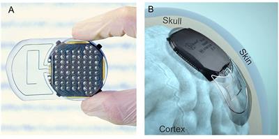 Long-Term Sheep Implantation of WIMAGINE®, a Wireless 64-Channel Electrocorticogram Recorder